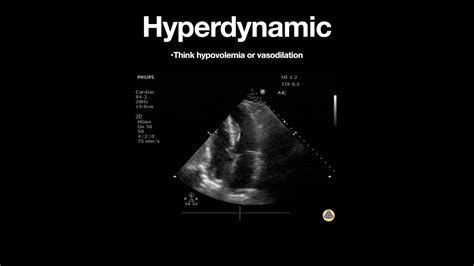 treatment of hyperdynamic left ventricle.